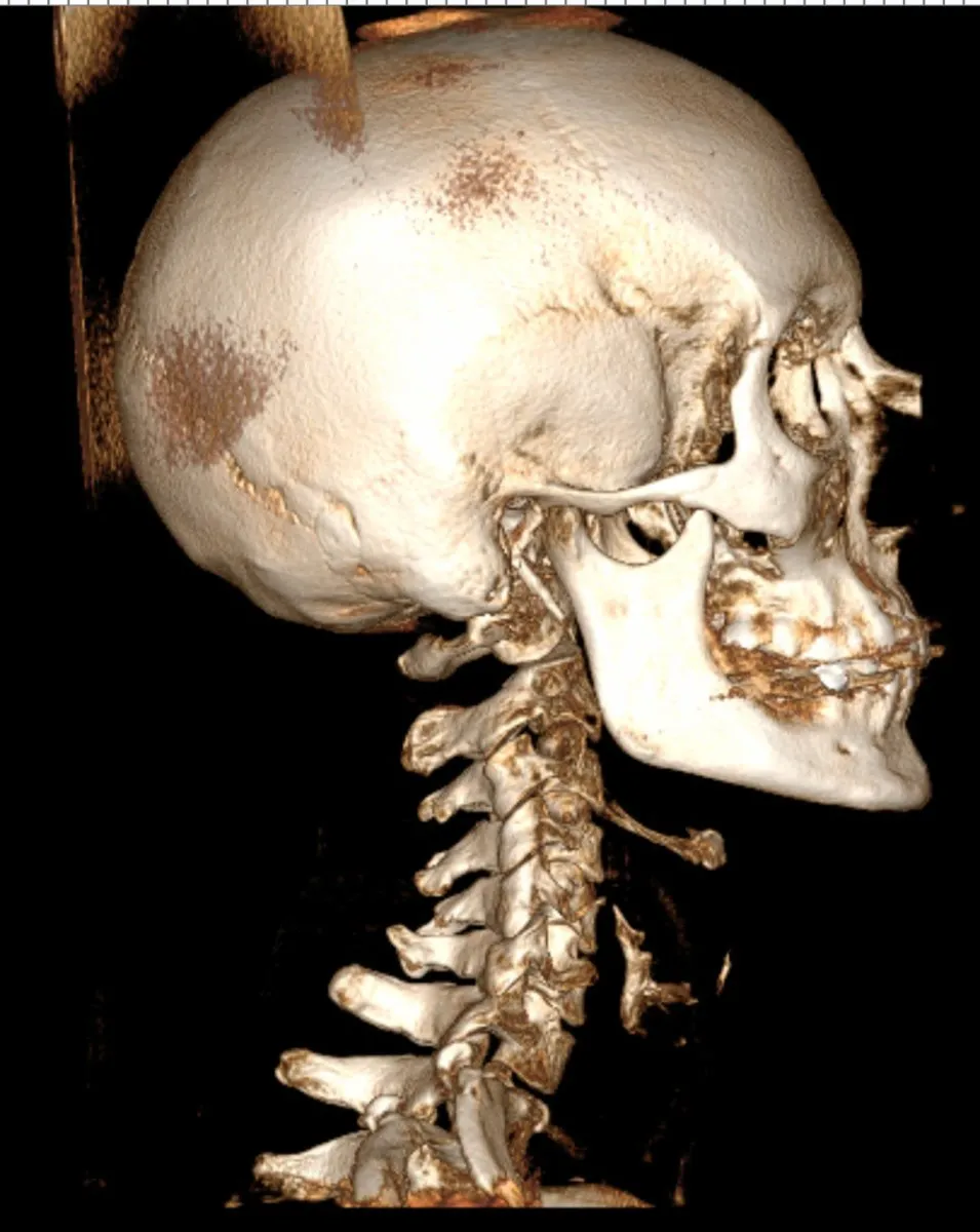 3D Cone Beam CT scan showing upper cervical spine and atlas alignment used in chiropractic care at Precision Chiropractic in Vermont.