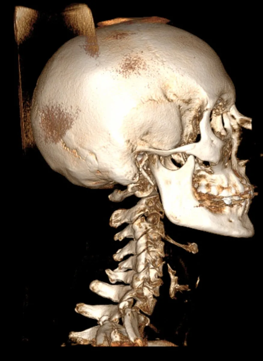3D Cone Beam CT scan showing upper cervical spine and atlas alignment used in chiropractic care at Precision Chiropractic in Vermont.
