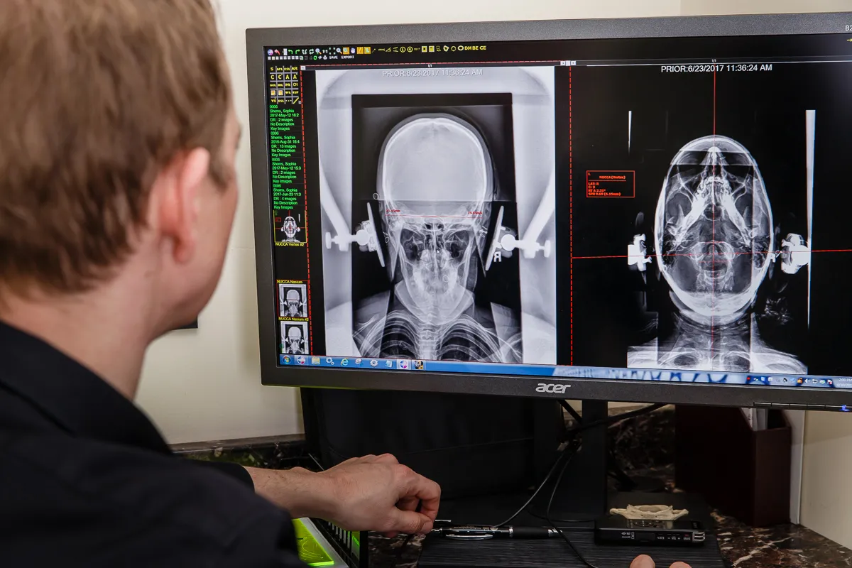 Close-up of high-frequency digital X-ray with alignment markers used to evaluate upper cervical spine structure at Precision Chiropractic Vermont.